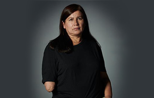 El desafío de prevenir amputaciones por accidente laboral